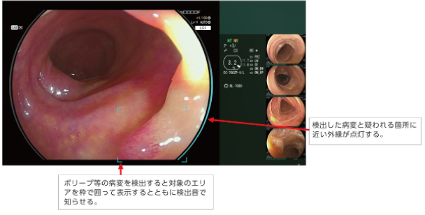 CAD EYE の病変検出支援機能:検出した病変を枠で囲い、外縁が点灯する表示画面