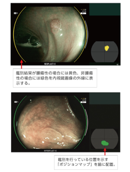 CAD EYE の疾患鑑別支援機能:腫瘍性は黄色・非腫瘍性は緑色で外縁とポジションマップに表示